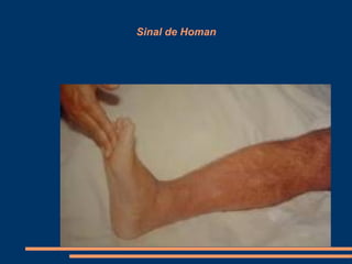 Sinal de Homan
 