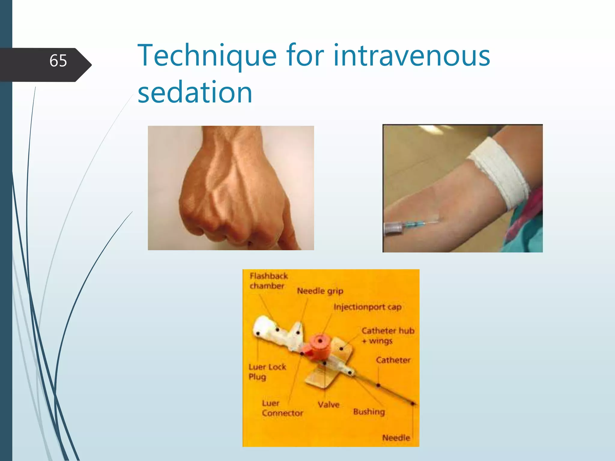 Technique for intravenous
sedation
65
 