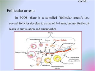 contd…
Follicular arrest:
In PCOS, there is a so-called "follicular arrest"; i.e.,
several follicles develop to a size of 5–7 mm, but not further, it
leads to anovulation and amennorhea.
 