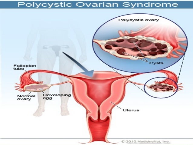 Pcos