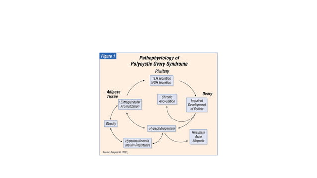 Polycystic ovarian disease revision notes (PCOD) | PDF | Hormonal ...