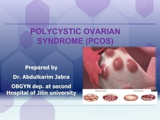 POLYCYSTIC OVARIAN
SYNDROME (PCOS)
Prepared by
Dr. Abdulkarim Jabra
OBGYN dep. at second
Hospital of Jilin university
1
 