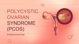 POLYCYSTIC
OVARIAN
SYNDROME
(PCOS)
Dr.Muhammad Zaid
 