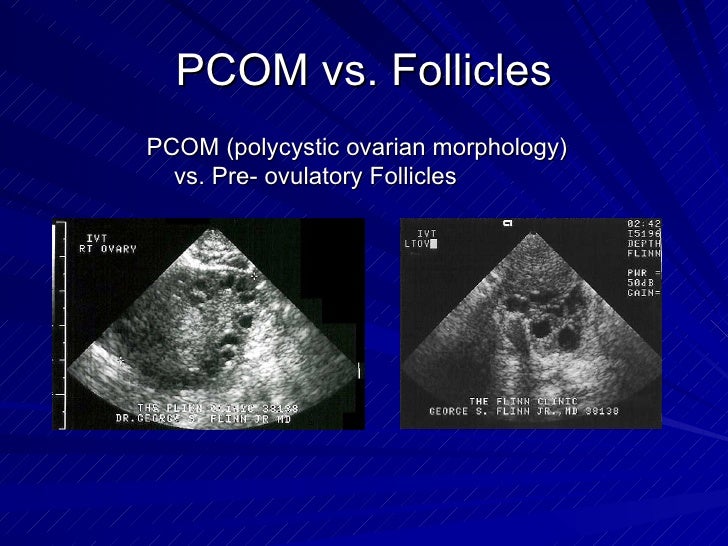 Infertility and PCOS