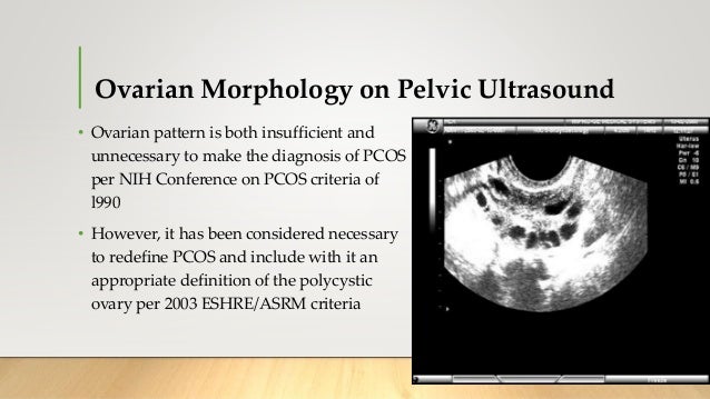 polycystic ovarian disease pcod