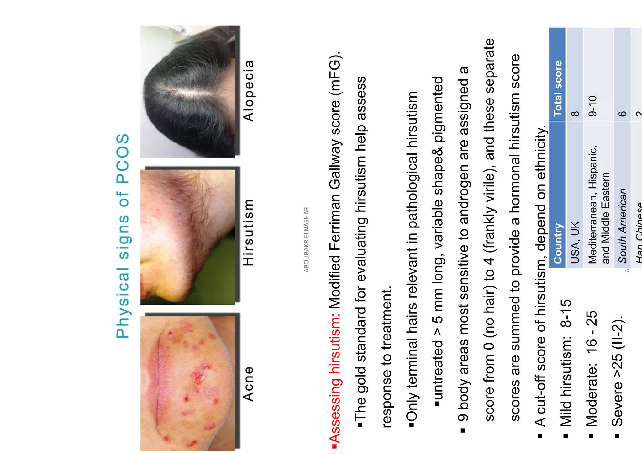 ABOUBAKR
ELNASHAR
ABOUBAKR
ELNASHAR
▪Assessing
hirsutism:
Modified
Ferriman
Gallway
score
(mFG).
▪The
gold
standard
for
evaluating
hirsutism
help
assess
response
to
treatment.
▪Only
terminal
hairs
relevant
in
pathological
hirsutism
▪untreated
>
5
mm
long,
variable
shape&
pigmented
▪
9
body
areas
most
sensitive
to
androgen
are
assigned
a
score
from
0
(no
hair)
to
4
(frankly
virile),
and
these
separate
scores
are
summed
to
provide
a
hormonal
hirsutism
score
▪
A
cut-off
score
of
hirsutism,
depend
on
ethnicity.
▪
Mild
hirsutism:
8-15
▪
Moderate:
16
-
25
▪
Severe
>25
(II-2).
ABOUBAKR
ELNASHAR
Country
Total
score
USA,
UK
8
Mediterranean,
Hispanic,
and
Middle
Eastern
9-10
South
American
6
 