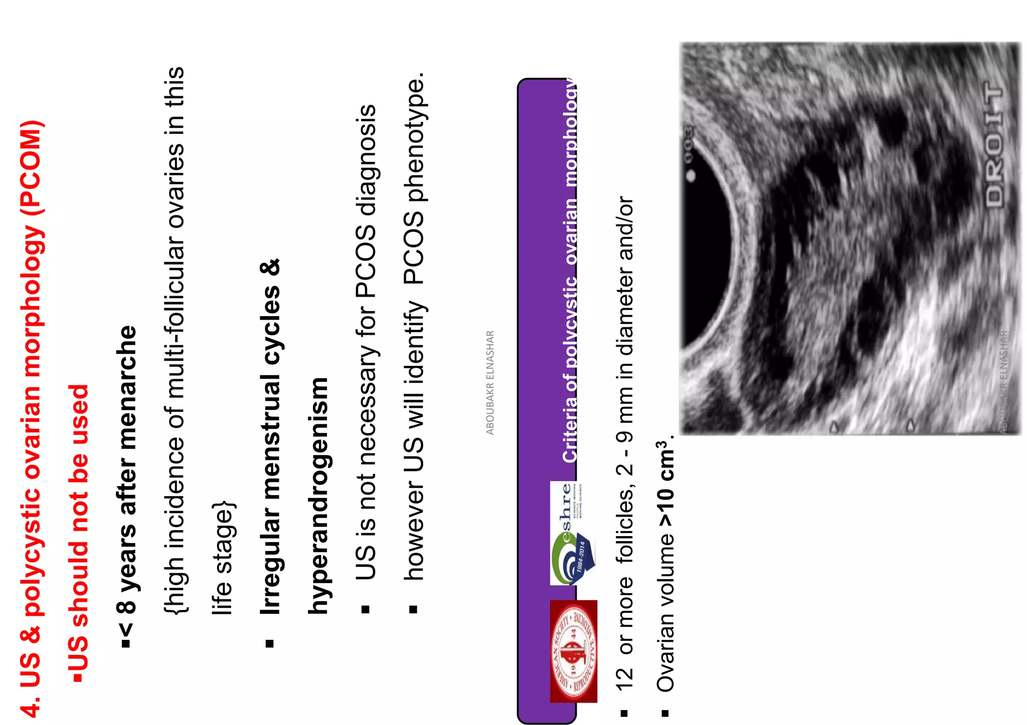 4.
US
&
polycystic
ovarian
morphology
(PCOM)
▪US
should
not
be
used
▪<
8
years
after
menarche
{high
incidence
of
multi-follicular
ovaries
in
this
life
stage}
▪
Irregular
menstrual
cycles
&
hyperandrogenism
▪
US
is
not
necessary
for
PCOS
diagnosis
▪
however
US
will
identify
PCOS
phenotype.
ABOUBAKR
ELNASHAR
Criteria
of
polycystic
ovarian
morphology
▪
12
or
more
follicles,
2
-
9
mm
in
diameter
and/or
▪
Ovarian
volume
>10
cm
3
.
ABOUBAKR
ELNASHAR
 