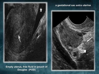 a gestational sac extra uterine




Empty uterus, free fluid in pouch of
         Douglas (POD)
 