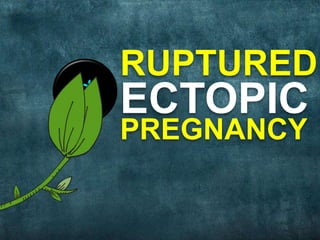 RUPTURED
ECTOPIC
PREGNANCY
 