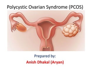 Polycystic Ovarian Syndrome (PCOS)
Prepared by:
Anish Dhakal (Aryan)
 
