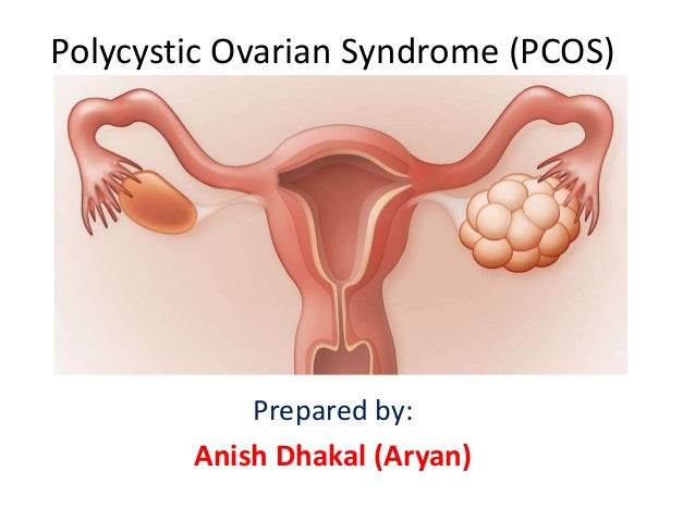 Polycystic Ovarian Syndrome Pcos By Dr Aryan