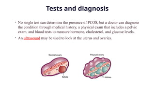 Polycystic ovary syndrome (PCOS) - Symptoms and causes | PPTX