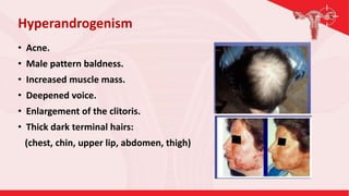 • Acne.
• Male pattern baldness.
• Increased muscle mass.
• Deepened voice.
• Enlargement of the clitoris.
• Thick dark terminal hairs:
(chest, chin, upper lip, abdomen, thigh)
Hyperandrogenism
 