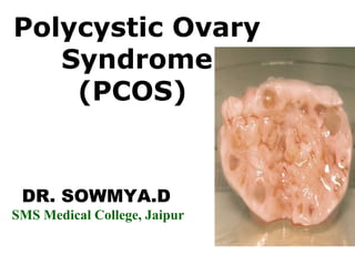 Polycystic Ovary 
Syndrome 
(PCOS) 
DR. SOWMYA.D 
SMS Medical College, Jaipur 
 