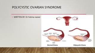 POLYCYSTIC OVARIAN SYNDROME
• WRITTEN BY: Dr Fatima nazeer
 