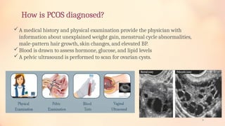 PCOS presentation all about ovaries pcod | PPTX