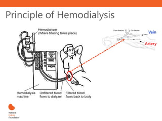 Principle of Hemodialysis
Vein
Artery
 