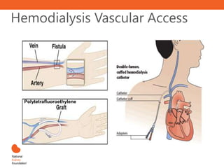 Hemodialysis Vascular Access
Polytetrafluoroethylene
 