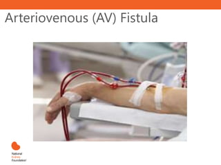 Arteriovenous (AV) Fistula
 