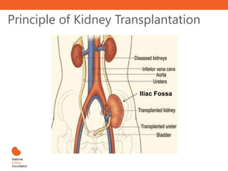Principle of Kidney Transplantation
Iliac Fossa
 