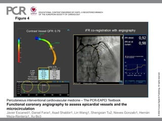 EDUCATIONAL CONTENT ENDORSED BY EAPCI, A REGISTERED BRANCH
OF THE EUROPEAN SOCIETY OF CARDIOLOGY
Figure 4
©
2022
Europa
Digital
&
Publishing.
All
rights
reserved.
Percutaneous interventional cardiovascular medicine – The PCR-EAPCI Textbook
Functional coronary angiography to assess epicardial vessels and the
microcirculation
Javier Escaned1, Daniel Faria1, Asad Shabbir1, Lin Wang1, Shengxian Tu2, Nieves Gonzalo1, Hernán
Mejía-Rentería1, Xu Bo3
 
