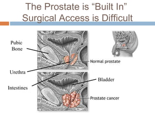 DrBlasko Low/IntermediateRiskProstateCancer(Sky/Teal) | PPT