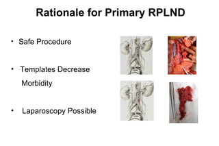 Left Template Rplnd ECCLU 2011 - N. Clarke - Testicular cancer - Role of surgery in the ...