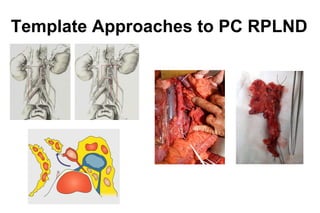 Left Template Rplnd ECCLU 2011 - N. Clarke - Testicular cancer - Role of surgery in the ...