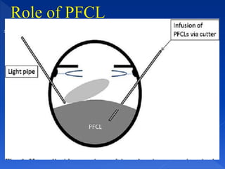 Posterior Float PCR management presentation of pcrPPT.pptx