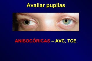 Avaliar pupilas ANISOCÓRICAS   – AVC, TCE   