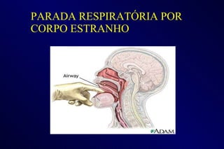 PARADA RESPIRATÓRIA POR CORPO ESTRANHO 