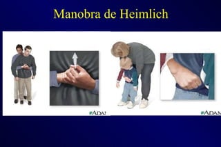 Manobra de Heimlich 