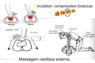 Massagem cardíaca externa: C irculation: compressões torácicas A  B  C  D 