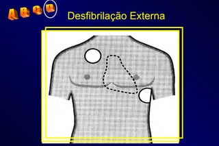 Desfibrilação Externa A  B  C  D 