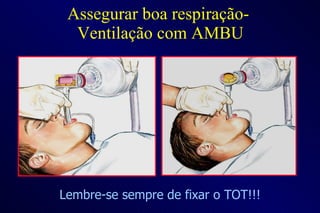 Assegurar boa respiração-  Ventilação com AMBU Lembre-se sempre de fixar o TOT!!! 