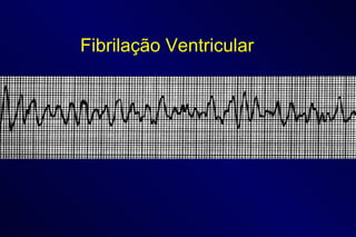 Fibrilação Ventricular 