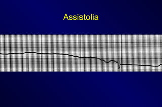 Assistolia 