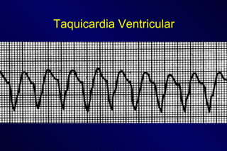 Taquicardia Ventricular 