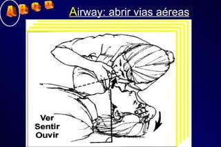 A irway: abrir vias aéreas A  B  C  D 