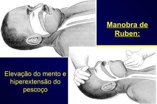 Manobra de Ruben: Elevação do mento e hiperextensão do pescoço 