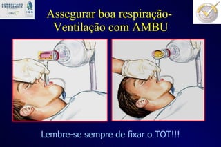Assegurar boa respiração-  Ventilação com AMBU Lembre-se sempre de fixar o TOT!!! 