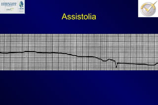 Assistolia 
