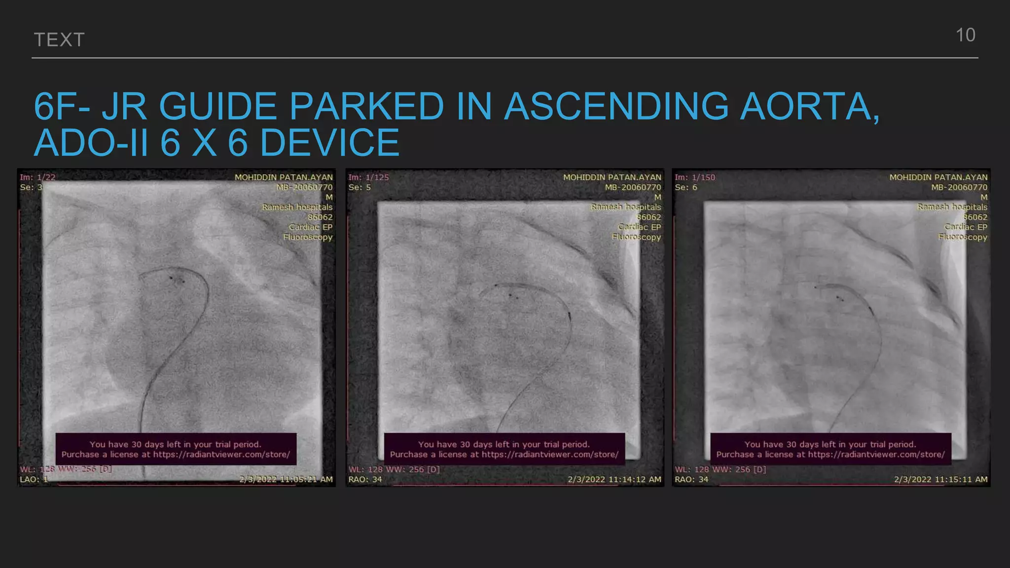TEXT
6F- JR GUIDE PARKED IN ASCENDING AORTA,
ADO-II 6 X 6 DEVICE
10