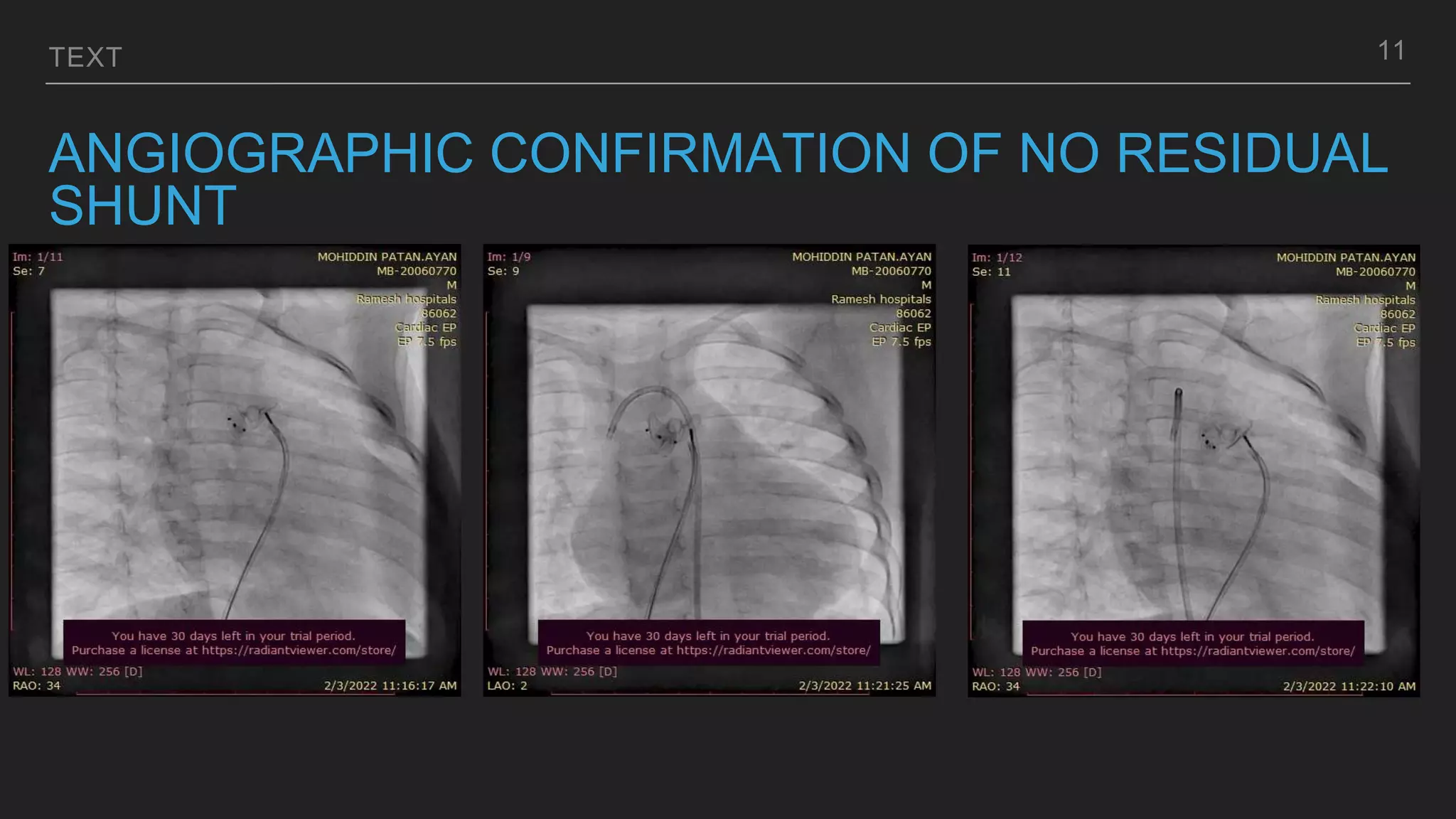 TEXT
ANGIOGRAPHIC CONFIRMATION OF NO RESIDUAL
SHUNT
11