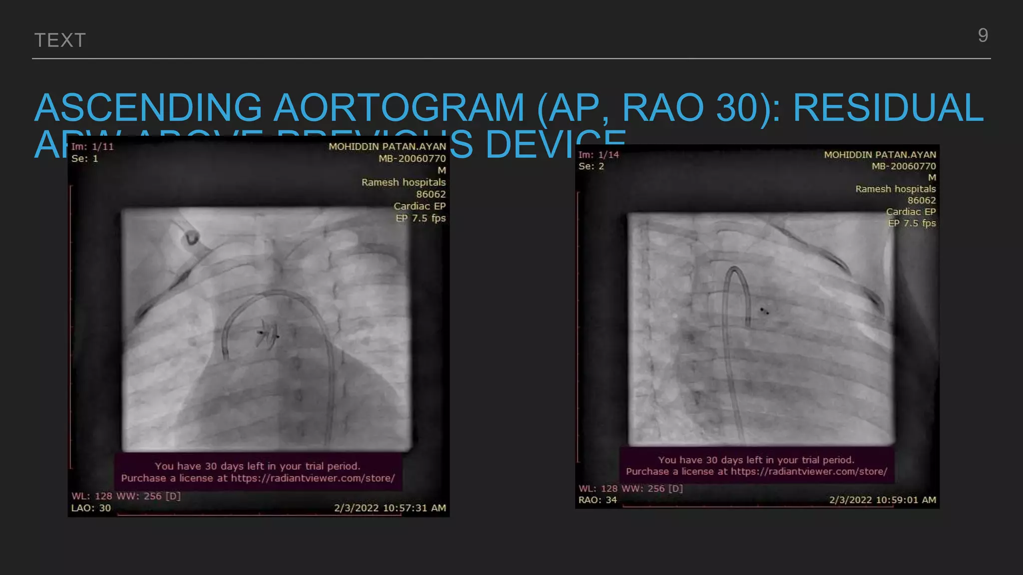 TEXT
ASCENDING AORTOGRAM (AP, RAO 30): RESIDUAL
APW ABOVE PREVIOUS DEVICE
9