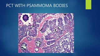 PCT WITH PSAMMOMA BODIES
 