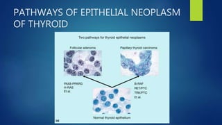 PATHWAYS OF EPITHELIAL NEOPLASM
OF THYROID
 