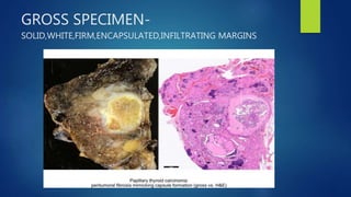 GROSS SPECIMEN-
SOLID,WHITE,FIRM,ENCAPSULATED,INFILTRATING MARGINS
 
