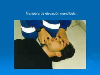 Maniobra de elevación mandibular
 