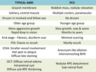 Polypoidal choroidal vasculopathy | PPTX